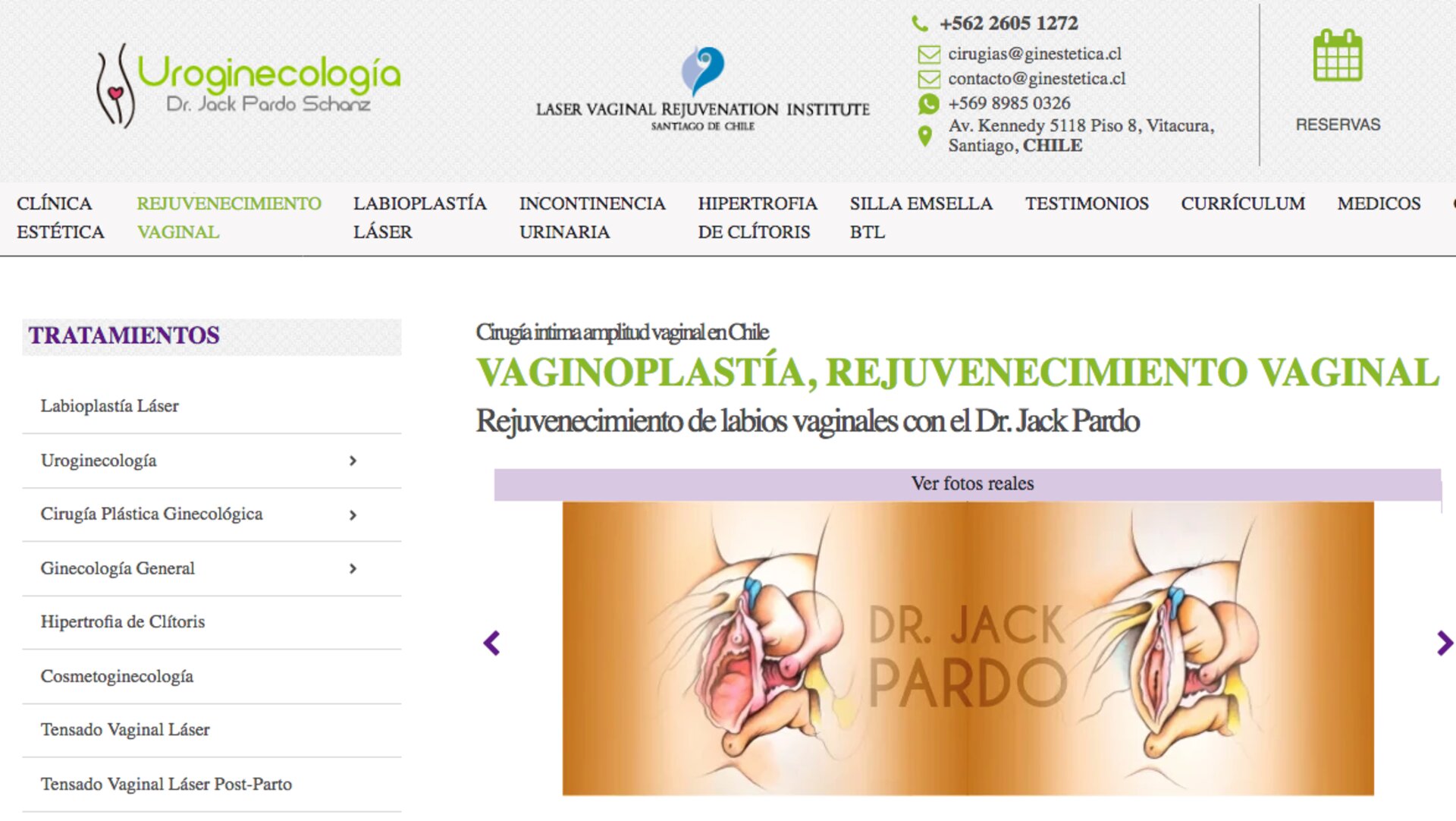 Labioplastía en santiago